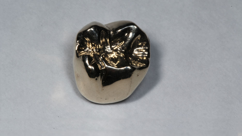 Full Cast Gold Restoration San Diego Cosmetic Dental Lab